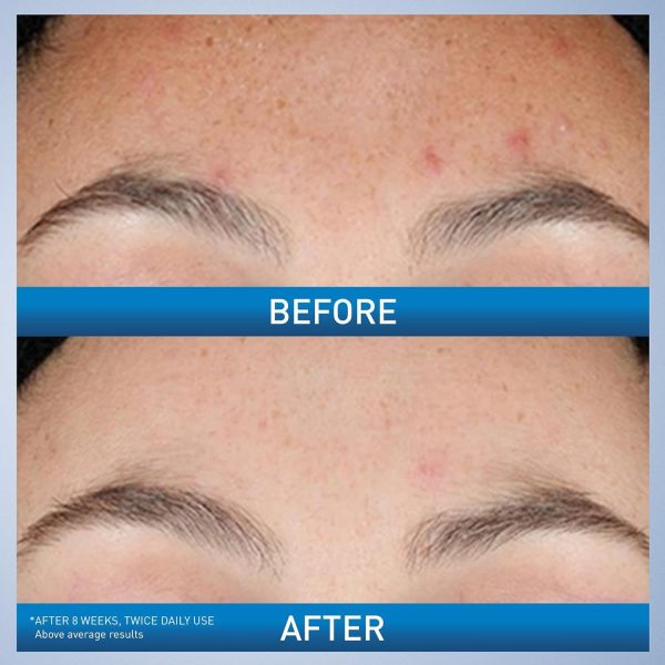 Cerave Resurfacing Retinol Serum For Post Acne Marks – 30ml