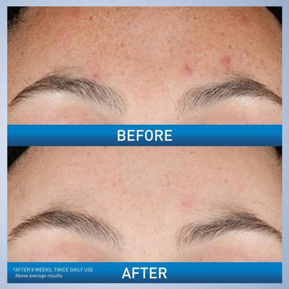 Cerave Resurfacing Retinol Serum For Post Acne Marks – 30ml