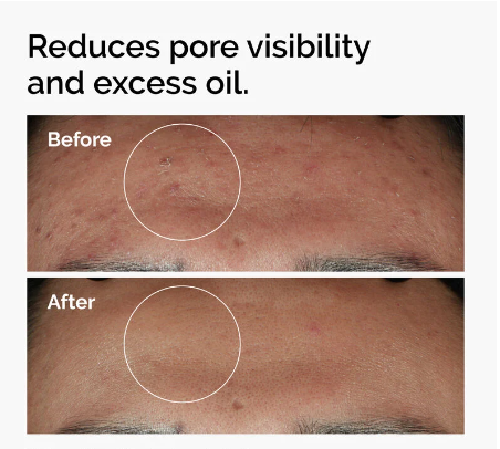 Ordinary Niacinamide 10% + Zinc 1%