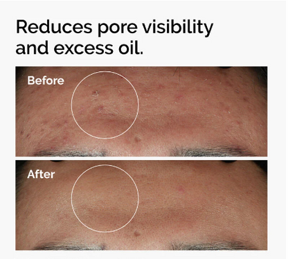 Ordinary Niacinamide 10% + Zinc 1%